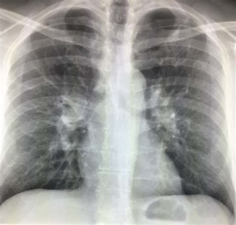 Infiltrate On Chest X-ray – Radiology In Plain English