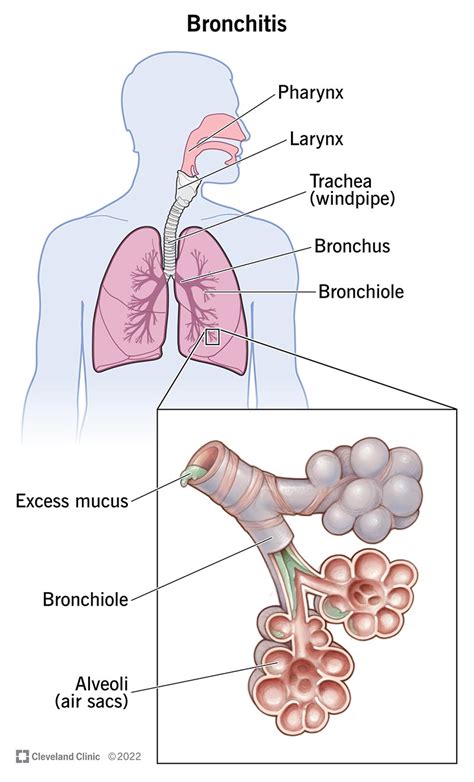 Top 10 signs and symptoms of bronchitis 2023