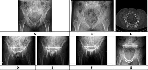 Shows a 67 year old patient who was treated with a sacroplasty... | Download Scientific Diagram