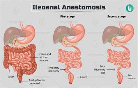 Ileoanal Anastomosis (J-pouch surgery): Procedure, Purpose, Results, Cost, Price