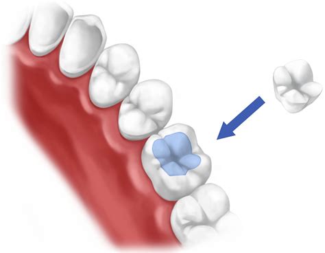 Professor Unveils First Data on Dental Fillings that Will Repair Tooth Decay - John Sarno DMD ...