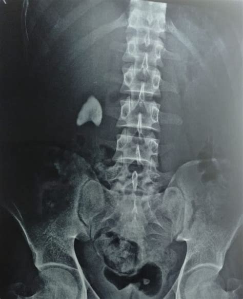 X Ray Or Ct Scan For Kidney Stone