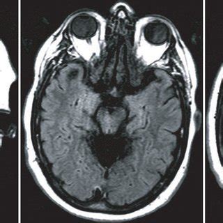 (PDF) Superficial siderosis: A case report and review of the literature