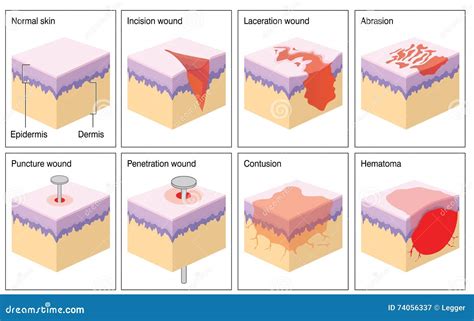 Skin wounds stock illustration. Illustration of hematoma - 74056337