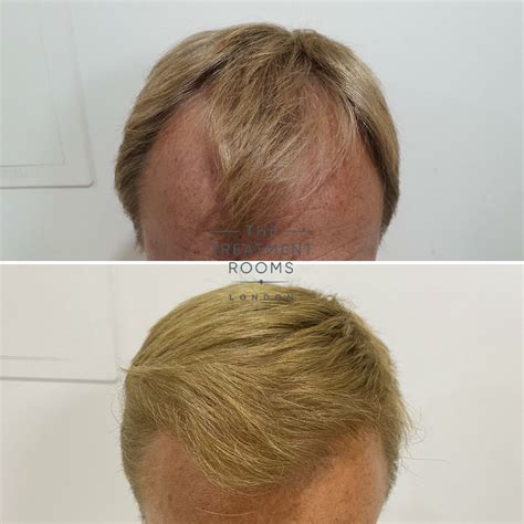 Norwood 3 Hair Loss: Everything You Need To Know | Get In Touch