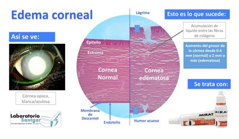 Edema Corneal - Laboratorio Santgar