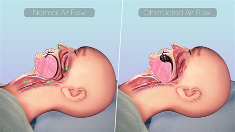 Sleep Apnea - Scientific Animations