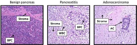 Pancreatitis Histology