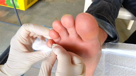 Infected Blister? How To Tell & What To Do About It - Blister Prevention