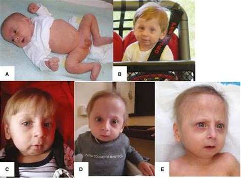 Hutchinson Gilford Progeria Syndrome Body