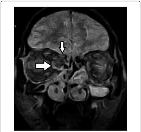 T2GRE coronal MR image shows fracture through cribriform plate and... | Download Scientific Diagram