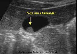 GALL BLADDER STONE-single hole surgery