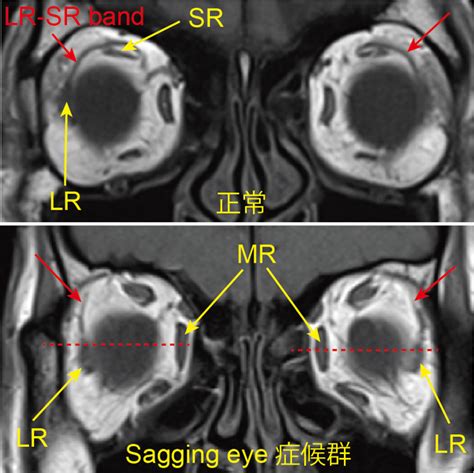 Sagging eye症候群 – 目医者情報