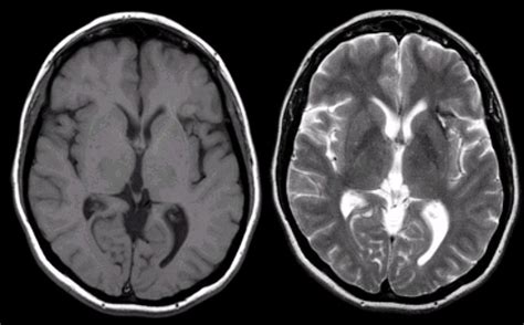 Hemorrhagic Stroke Mri