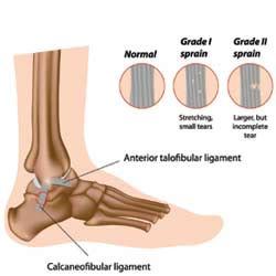 Causes of Severe Ankle Joint Pain