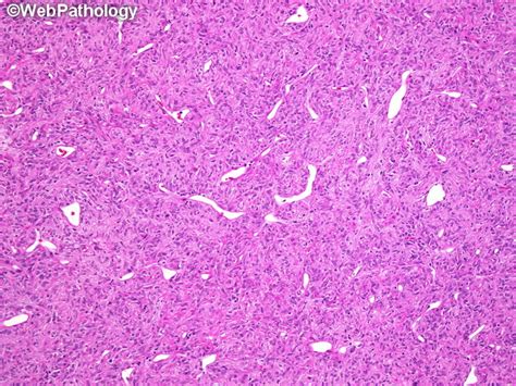 Webpathology.com: A Collection of Surgical Pathology Images