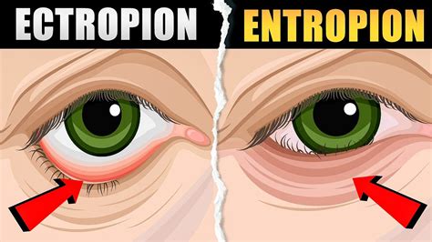 Entropion And Ectropion Causes Symptoms And Treatment