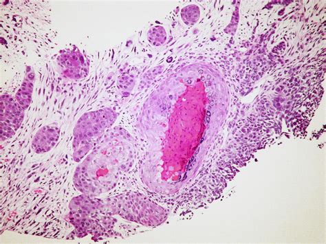 Small cell carcinoma, combined, with squamous cell carcino… | Flickr