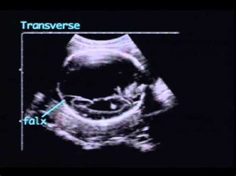 hydranencephaly - YouTube