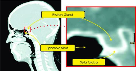 Sella Turcica Anatomy