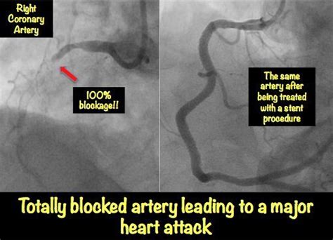 Heart Blockage: Explained with Pictures • MyHeart