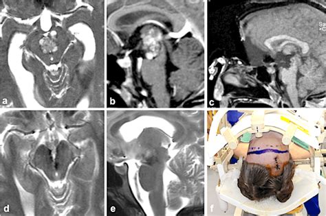 This 21-year-old woman presented with transient oculomotor nerve palsy;... | Download Scientific ...