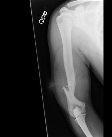 Distal End Humerus Fracture