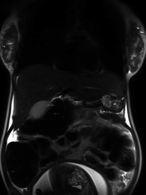 MRI of abdomen without contrast MRI showing obstruction of the distal ...