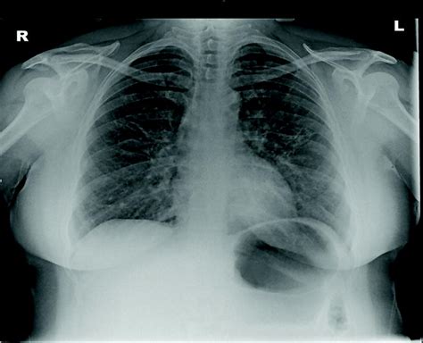 7: Diffuse parenchymal lung disease | Thoracic Key