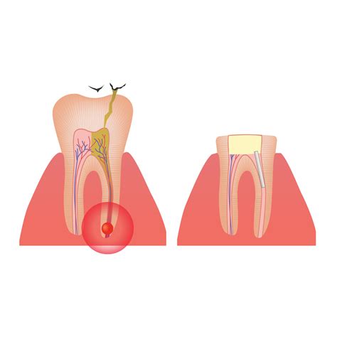 Root Canal Infection Symptoms - Queens, NY