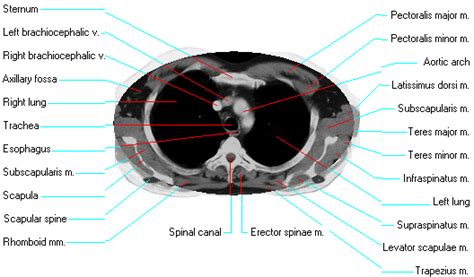 Ct Thorax Anatomy - Anatomical Charts & Posters