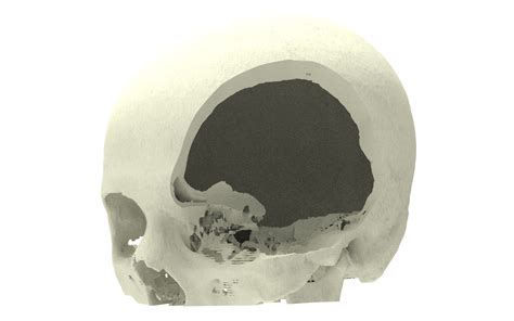 Meningioma resection + reconstruction | Xilloc