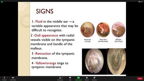 Otitis media with effusion - YouTube