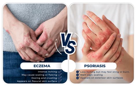 Eczema & Psoriasis – Ko Skin Specialist