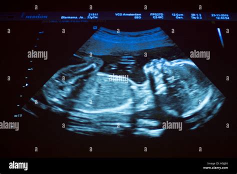 Embryo ultrasound hi-res stock photography and images - Alamy