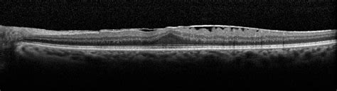 Macular Pucker Surgery When Can You Read Again - Perez Senter