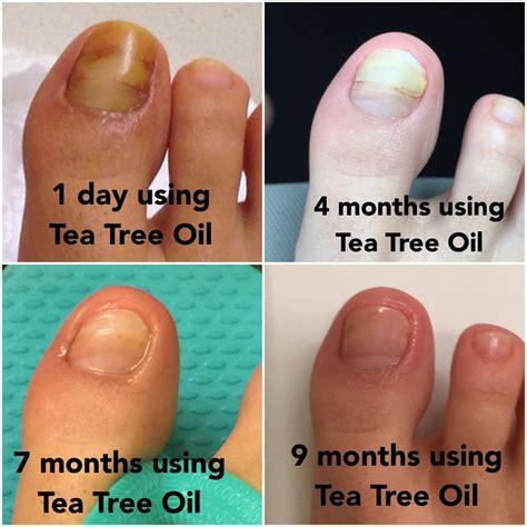 Amazon.com: Tea Tree Oil Foot Soak With Epsom Salt, Helps Treat Nail Fungus , Athletes Foot ...