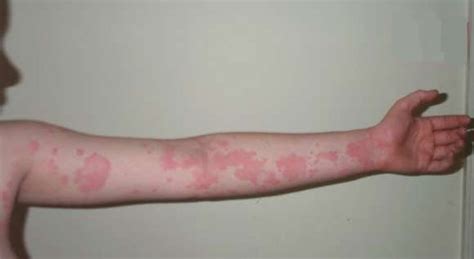 Anaphylaxis Rash