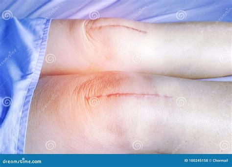 Scars Surgical Knee Surgery Stock Photo - Image of hurt, adult: 100245158