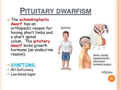 Hypopituitary Dwarfism Vs Achondroplasia