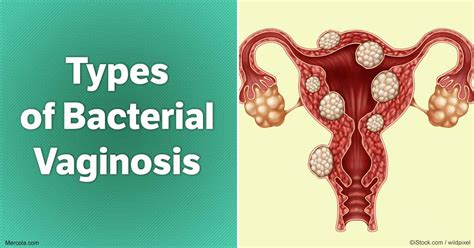 What Are the Types of Bacterial Vaginosis?