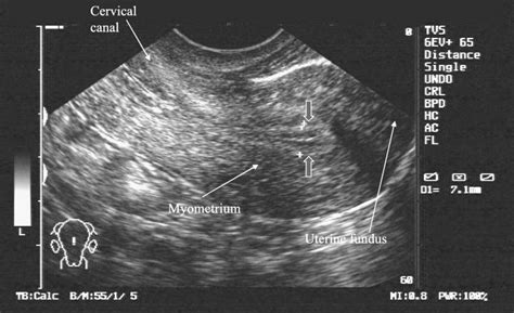 The Validity Of Transvaginal Ultrasound Measurement Of Endometrial ...