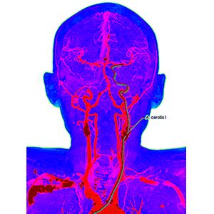 Carotid Artery Stenosis: What You Should Know