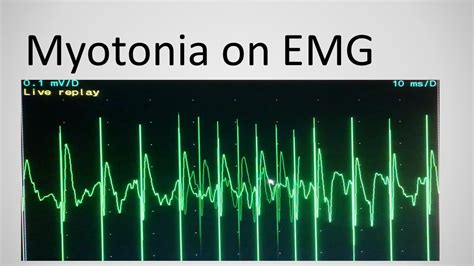 Myotonia on EMG - YouTube