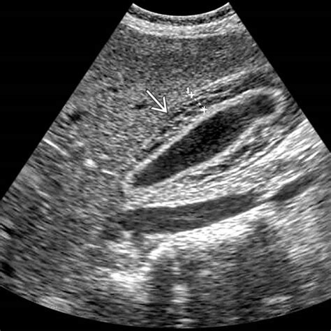 Viral Hepatitis | Radiology Key