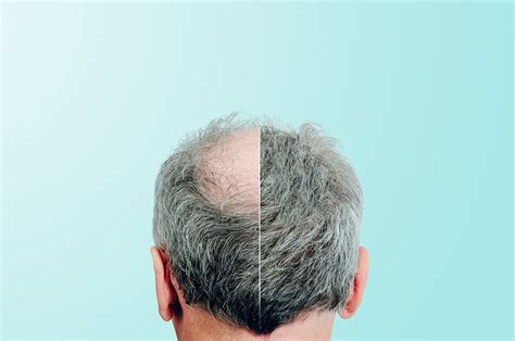 Biofibre Hair Transplant | New Birkdale Clinic