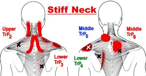 What Causes Neck Pain And Stiffness