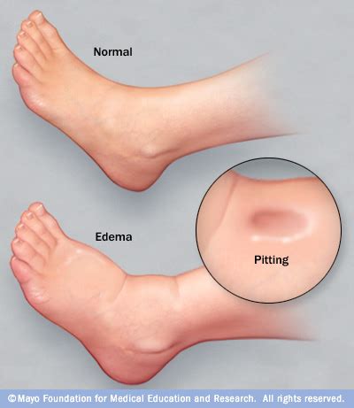 Edema Disease Reference Guide - Drugs.com