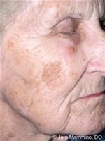 Pigmentation Disorders - Diseases of the Skin