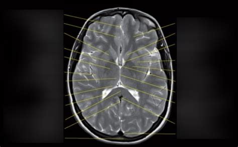 Diagram of coronal MRI BRAIN | Quizlet